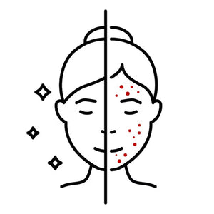 HORMONAL ACNE